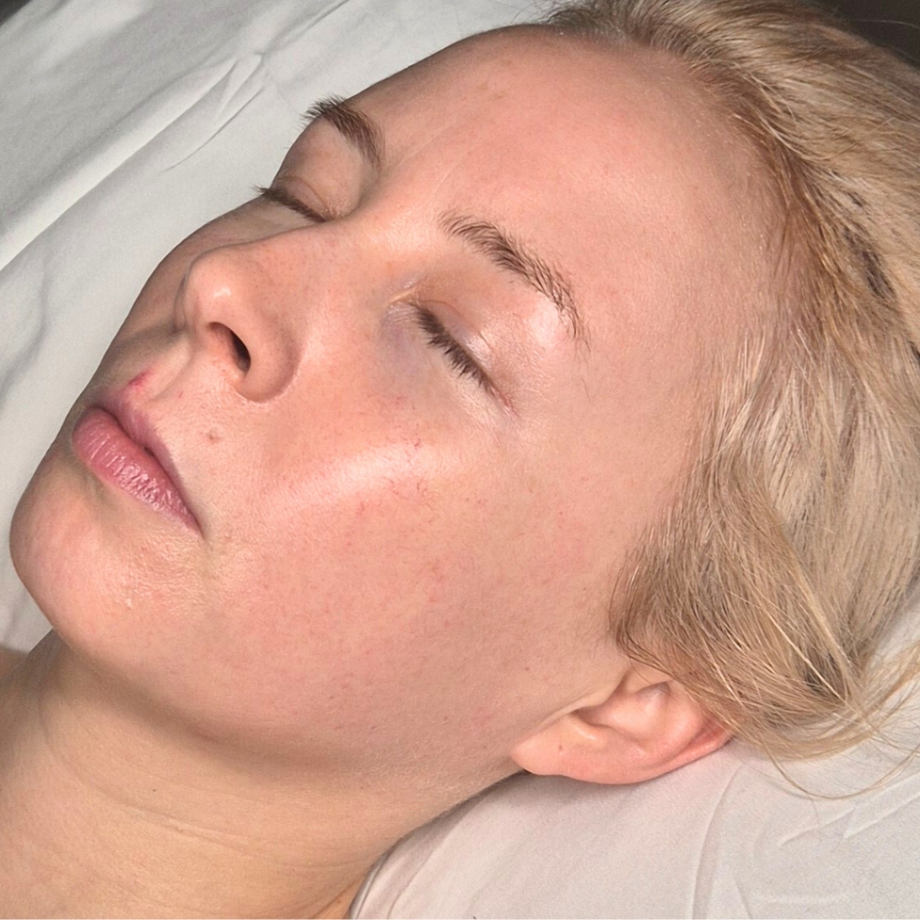 Woman receiving a Rejuvenation Peel facial treatment at Nicola McLaughlin Skincare clinic, designed to unclog pores, reduce breakouts, and smooth skin texture